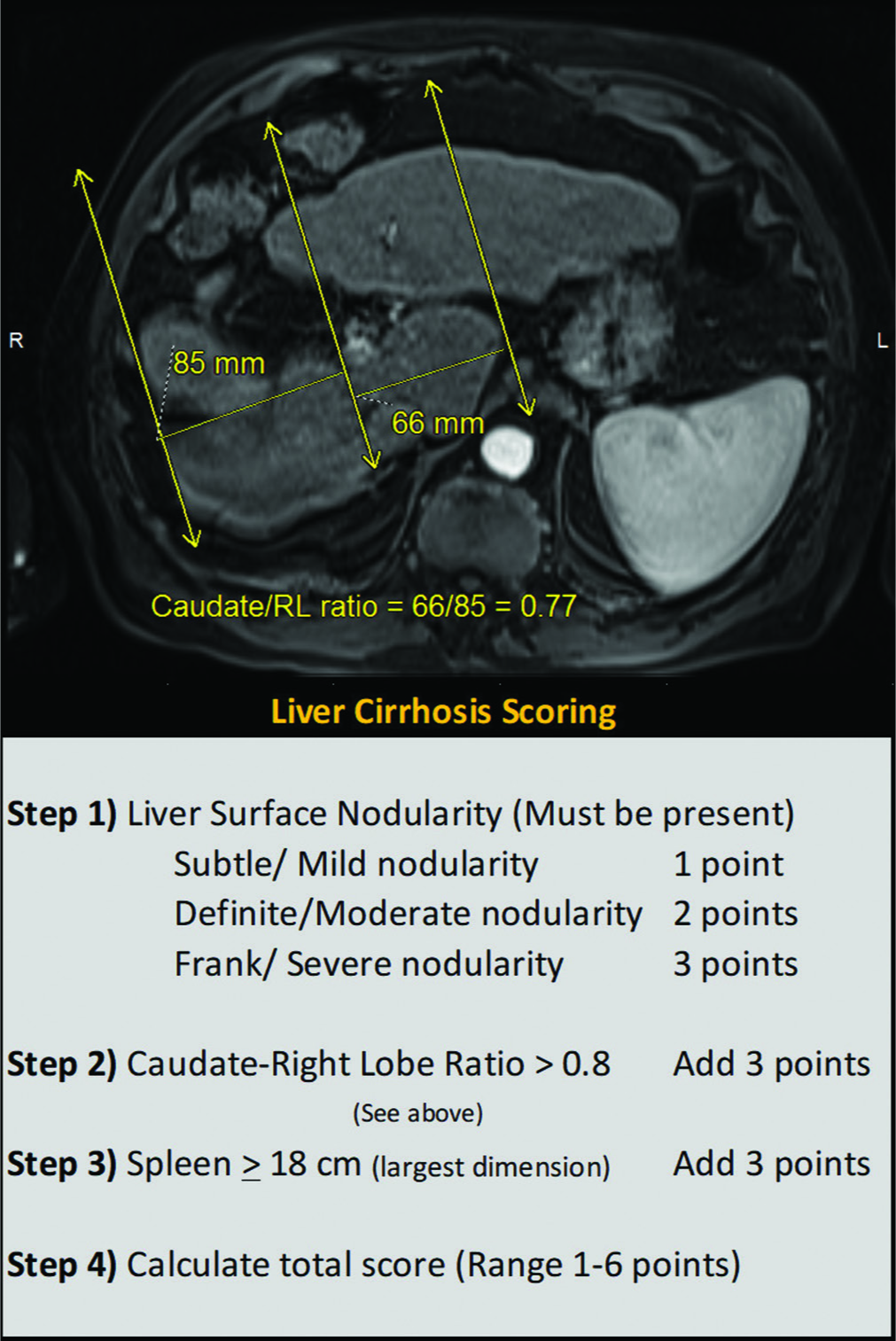 Imaging grading for cirrhosis: T2-weighted magnetic resonance imaging through the liver demonstrating steps in the calculation of caudate to right lobe ratio is shown above and the semiquantitative morphologic cirrhosis grading used is tabulated below.