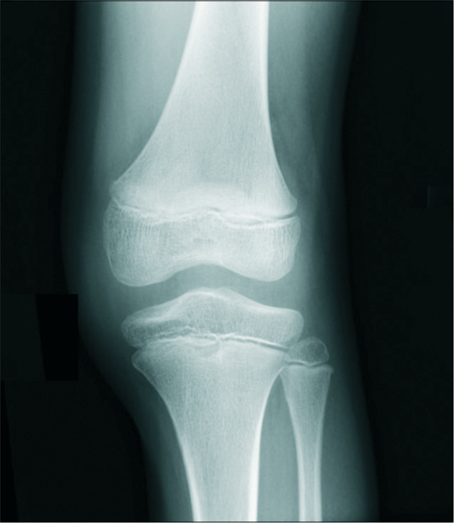 A 10-year-old male with chronic left knee pain. Anteroposterior radiograph of the left knee shows widened medial and lateral tibiofemoral compartments, which can be seen with discoid menisci.