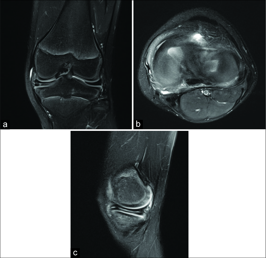 (a) A 10-year-old male with chronic left knee pain. Coronal fluid weighted fat-saturated sequence shows a complete medial and incomplete lateral discoid meniscus. There is also a horizontal tear of the medial meniscus, (b) axial fluid weighted fat- saturated sequence shows a complete medial and incomplete lateral discoid meniscus, (c) sagittal fluid weighted fat-saturated sequence shows a horizontal tear of the medial discoid meniscus which propagated into the posterior root attachment.