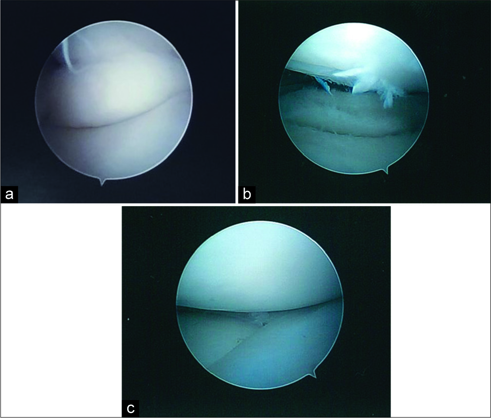 (a) Arthroscopic view of the medial discoid meniscus between the medial femoral condyle and tibial plateau with the knee slightly extended. The femoral condyle pushed the posterior horn of the discoid meniscus into the joint. (b) Arthroscopic view of the medial discoid meniscus s/p saucerization revealing the horizontal tear noted on magnetic resonance imaging. (c) Arthroscopic view of the lateral discoid meniscus. This meniscus was not as markedly discoid as the medial meniscus.