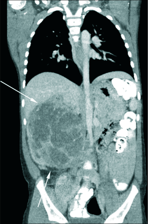 4-year-old girl presenting for an asymptomatic abdominal mass. Contrast enhanced coronal computed tomography demonstrates a large, heterogeneously enhancing lesion, with significant mass effect on nearby structures in the abdomen, consistent with a Wilms tumor.