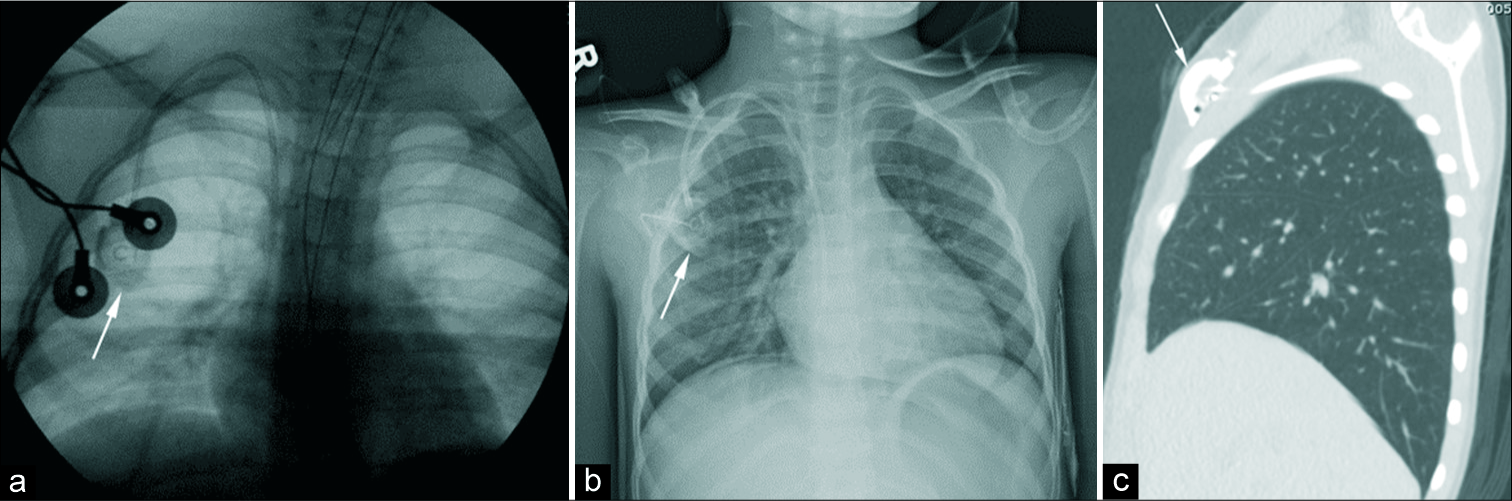 4-year-old girl with a history of Wilms tumor status-post excision has flouroscopic imaging (a) and an anteroposterior chest radiograph (b) demonstrating placement of a right-sided chest port. A sagittal computed tomography (c) redemonstrates the placement of the chest port.