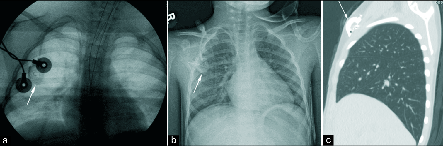 Satisfaction of Search: Recurrent Wilms Tumor Mimicking Chest Port