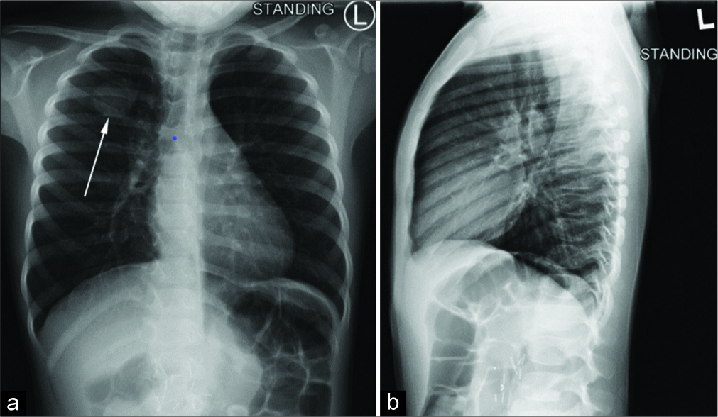 5-year-old girl presenting for routine surveillance imaging nine months after surgical resection of a Wilms tumor, followed by chemotherapy. (a) Anterior-posterior plain chest radiography demonstrates an opacity in the right upper region of the chest. (b) The opacity is not present in the sagittal view. The opacity was accompanied by a palpable mass over the right upper chest, and was thought to be scar tissue from a recently explanted chest port over the area.
