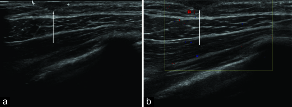 5-year-old girl with a history of Wilms tumor status-post excision and chemotherapy presents for follow up of an opacity seen on chest radiograph. Superficial axial sonography of the right upper chest wall demonstrates a hypoechoic, subcutaneous mass. The size of the mass, however, did not correlate to the opacity on the surveillance chest radiograph.