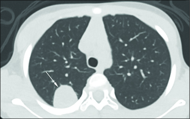 5-year-old girl with a history of Wilms tumor, and mass seen on surveillance chest radiograph. Contrast enhanced axial CT of the chest of demonstrates an enhancing lesion in the right posterior lung, consistent with metastatic Wilms tumor.