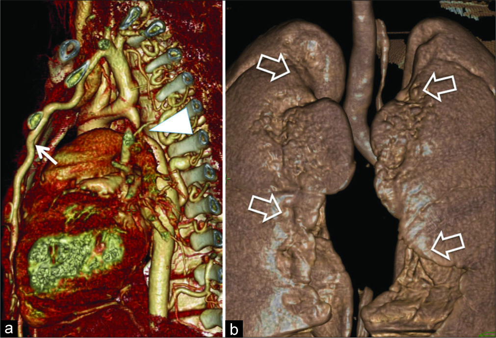 An 18-year-old male with coarctation of aorta presented with incidentally detected hypertension. Computed tomography 3D angiogram (a) demonstrates post-ductal coarctation (arrowhead) and enlarged, hypertrophic internal mammary artery (white arrow). (b) On a 3D surface rendered anterior view, there is an irregular pleural interface along internal mammary arteries (open arrows).