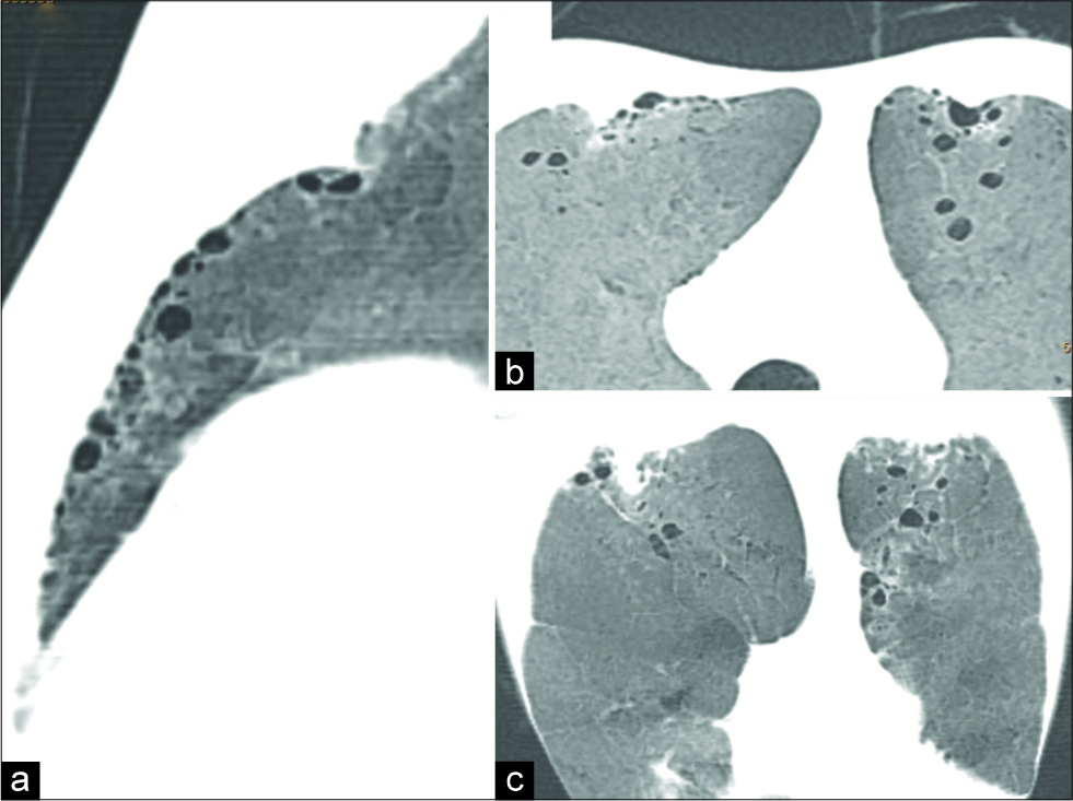An 18-year-old male diagnosed with coarctation presented with incidentally detected hypertension. Computed tomography minimal intensity projection images (a) sagittal, (b) axial, and coronal (c) orientation demonstrate subpleural cysts in anterior part of upper lobes along the path of internal mammary arteries.