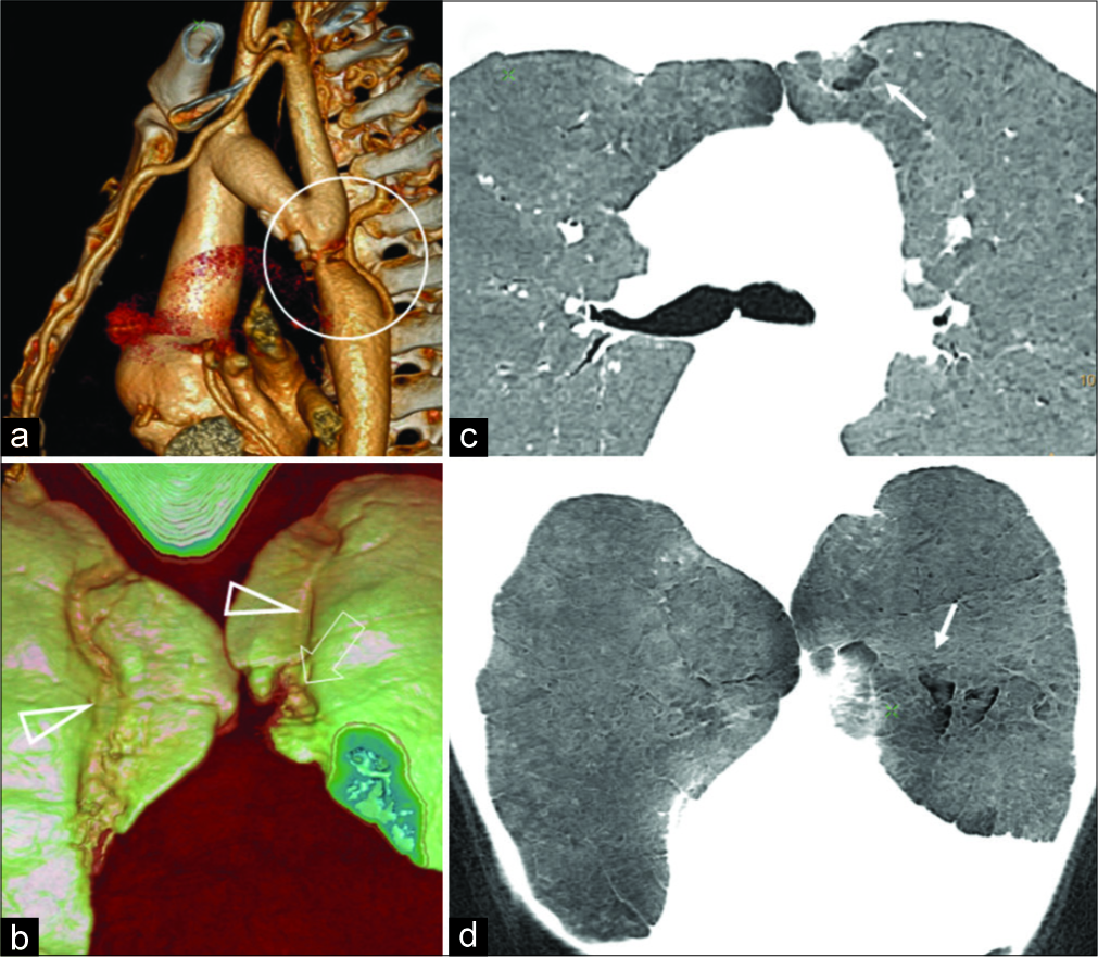 A 22-year-old male with coarctation of aorta presented with throbbing headache, exertional dyspnea shows (a) post-ductal coarctation (circle) with dilated internal mammary artery on surface rendered 3D image. (b) 3D surface rendered image of the anterior lungs shows prominent groove for internal mammary arteries with irregular pleural surface on the left side. Axial and coronal (c and d) minimal intensity projection image demonstrates vertically oriented hyperlucency bilaterally, with more extensive change on the left side (arrow).