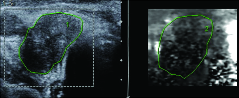 A 62-year-old male presented with swelling of the thyroid gland and palpable cervical lymph nodes. Ultrasonography and corresponding virtual touch imaging image of a malignant lymph node demonstrating that the node is darker than the surrounding tissue. Histopathological examination was reported as papillary thyroid carcinoma with nodal involvement.