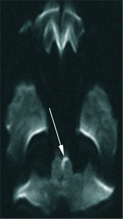 A 6-year-old girl presented with right-sided weakness. The initial axial diffusion-weighted imaging was done at an outside hospital, but due to significant skull base artifact, a small area of restricted diffusion may have been overlooked.