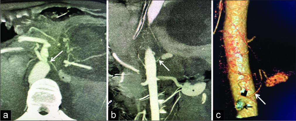 A 20-year-old gentleman diagnosed as acute pancreatitis presented with hypovolemic shock and fall in hemoglobin. Computed tomography angiogram: (a) Axial, (b) coronal, and (c) volume rendered tomography images. A large pseudo aneurysm (*) is seen arising from the left adrenal artery (white arrow). Offending artery is seen arising as a left anterolateral branch of abdominal aorta (black arrowhead in c), just superolateral to coeliac trunk (black arrow in c).