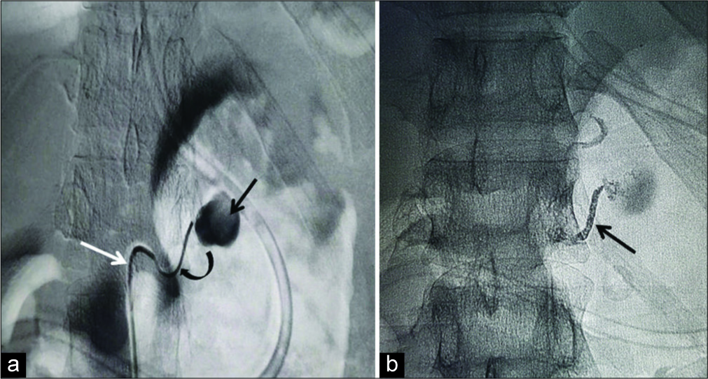 A 20-year-old gentleman diagnosed as acute pancreatitis presented with hypovolemic shock and fall in hemoglobin. (a) Digital subtraction angiography shows the pseudoaneurysm (black arrow in a) arising from the left middle adrenal artery. Cannulation was done with RDC catheter (white arrow in a) with coaxially introduced micro catheter (curved arrow in a). (b) Shows a fluoroscopic spot image obtained after trans catheter N-butyl cyanoacrylate: lipiodol (1:3) embolization which shows glue cast in the left middle adrenal artery (black arrow in b).