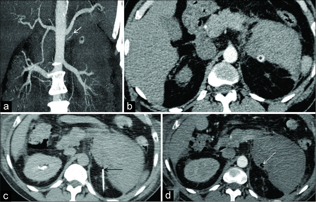 A 50-year-old gentleman with a diagnosis of unclassified vasculitis presented in shock with a fall in hemoglobin. Coronal maximum intensity project (a) and axial contrast-enhanced computed tomography (CT) angiography (b) shows a small pseudo aneurysm (*) at left supra renal region arising from left middle adrenal artery (white arrow) (c) shows direct puncture of the aneurysm sac under CT guidance with the help of a Chiba needle (black arrow). (d) Axial CT angiographic study performed after embolization with N-butyl cyanoacrylate shows glue cast (white arrow) with the absence of filling of the pseudo aneurysm sac.