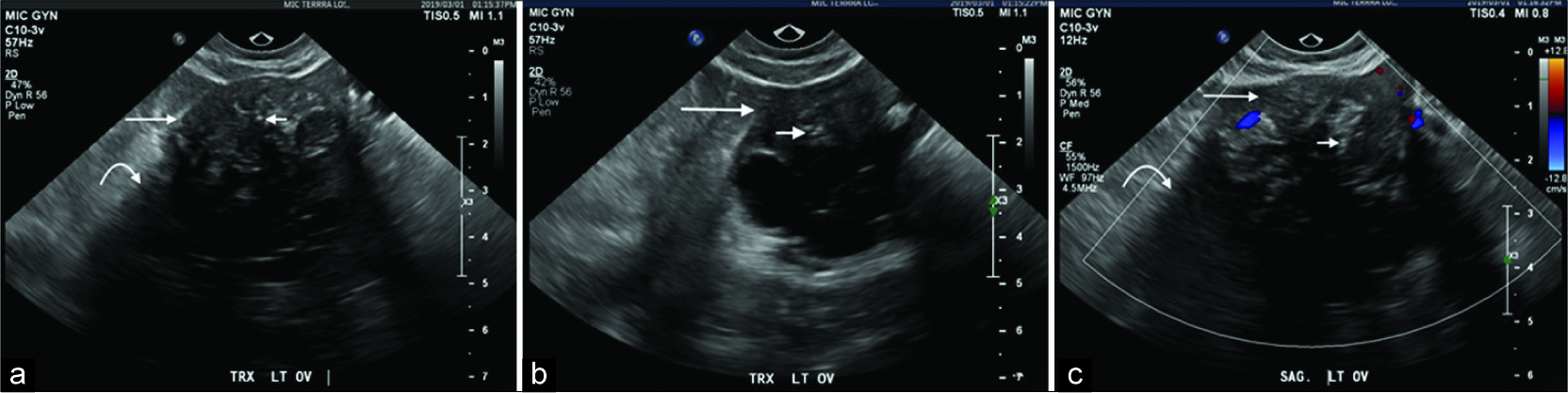 A 40-year-old female underwent a pelvic ultrasound for abnormal uterine bleeding. Axial (a and b) and sagittal (c) ultrasound images demonstrate an incidental complex left adnexal lesion with a solid component demonstrating diffuse hypoechogenicity (long arrow) and posterior shadowing (curved arrow) in addition to punctate echogenic calcifications (short arrow) with internal Doppler enhancement.