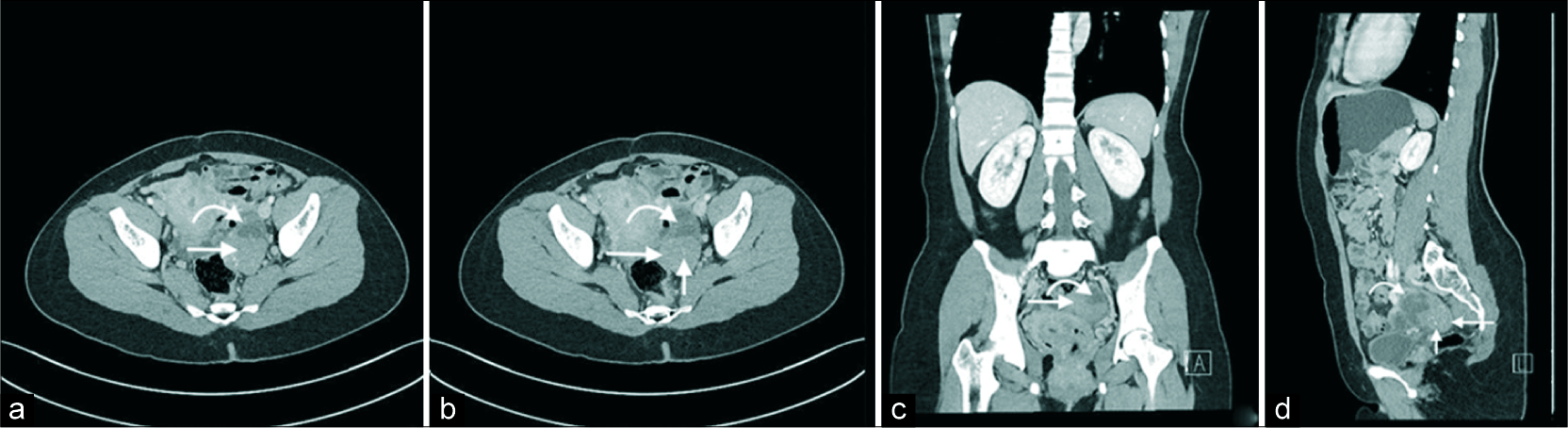 A 40-year-old female with an incidental left adnexal lesion on ultrasound underwent subsequent computed tomography (CT) imaging. Axial (a and b), coronal (c), and sagittal (d) CT images demonstrate an enhancing solid (long arrow) and cystic (curved arrow) left adnexal mass with thinly septated amorphous and punctate calcifications (short arrow).