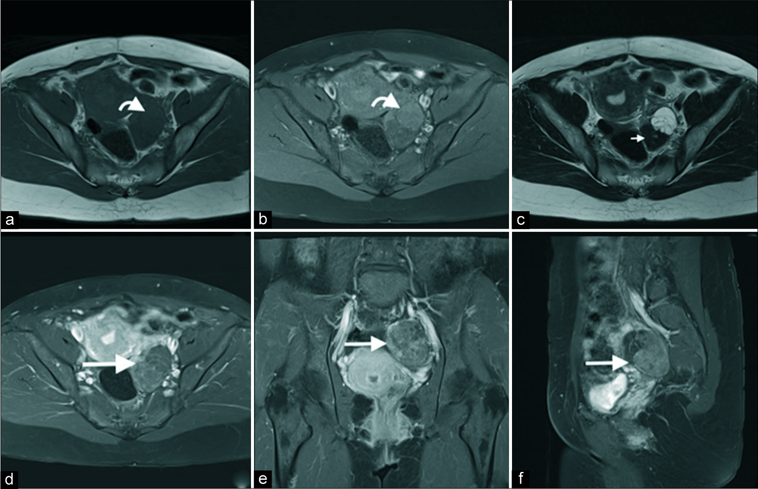 A 40-year-old female with an incidental left adnexal lesion on ultrasound underwent subsequent magnetic resonance imaging (MRI). Axial T1 (a), T1 fat saturation (b), T2 (c), axial (d), coronal (e), and sagittal post-gadolinium MRI sequences demonstrate an enhancing cystic (anterior) and solid (posterior) lesion (d-f, long arrow) with mild T1 hyperintensity of the cystic component (a and b, curved arrow) and markedly T2 hypointensity of the dominant solid fibrous component (c, short arrow). No central necrosis was present.