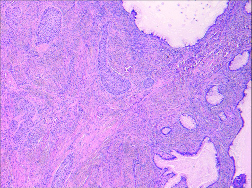 A 40-year-old female underwent surgical excision of an incidental left adnexal lesion. Hematoxylin and eosin stain (50×) of the surgical specimen is demonstrated. Nests of transitional- type epithelium within a fibrous stroma characteristic for Brenner tumor were present (left) in association with a cystic tumor showing a single row of uniform mucin-rich columnar cells with basal nuclei lining glands and cysts characteristic for mucinous cystadenoma (right). The microscopic appearance correlated with macroscopic features of both solid and cystic areas within the tumor.