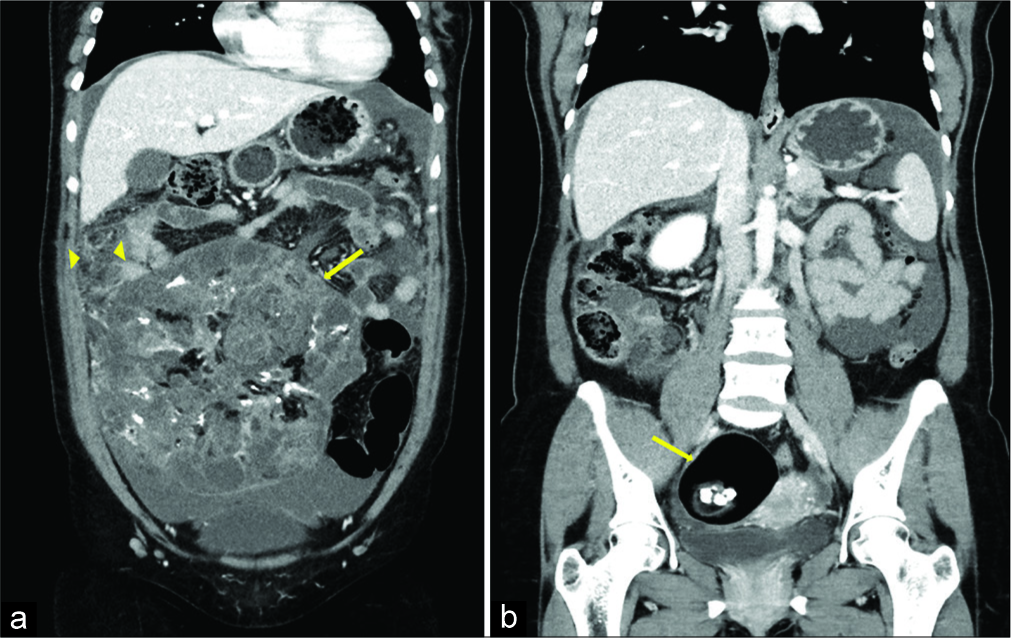 A 32-year-old woman presenting with progressively worsening abdominal pain subsequently diagnosed with bilateral teratomas (immature and mature). Coronal reformats of contrast- enhanced CT of the abdomen and pelvis (a) demonstrates a large, heterogeneous soft-tissue mass (arrow) with a small amount of fat and calcifications. Omental fat stranding (arrowheads) is seen along the right superolateral aspect of mass along with small volume ascites (a). Additional coronal image (b) demonstrates a well- circumscribed mass in the right adnexa (arrow) with intralesional fat and calcifications.