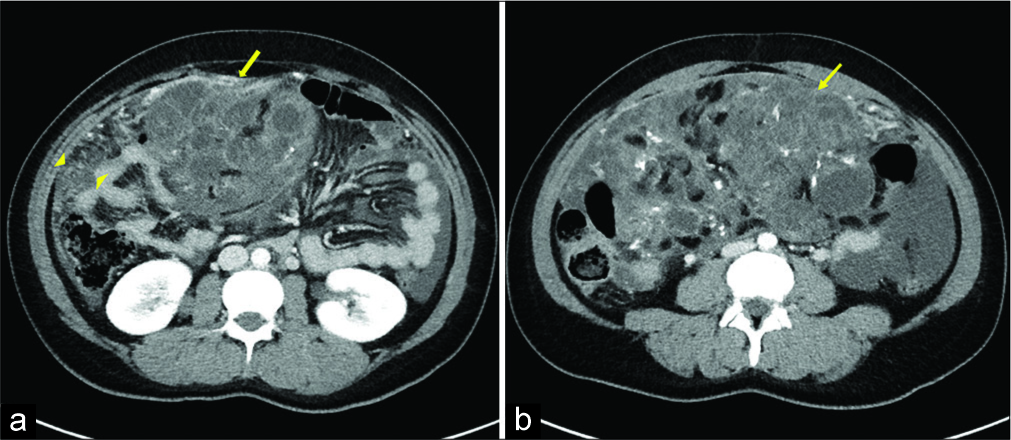 A 32-year-old woman presenting with progressively worsening abdominal pain subsequently diagnosed with bilateral teratomas (immature and mature). Axial contrast-enhanced computed tomography of the abdomen and pelvis (a) demonstrates a large heterogeneous soft-tissue pelvic mass (arrow) with internal fat with surrounding omental fat stranding (arrowhead). Additional axial image (b) demonstrates a large heterogeneous soft-tissue pelvic mass with small amount of fat and calcification, consistent with immature teratoma.