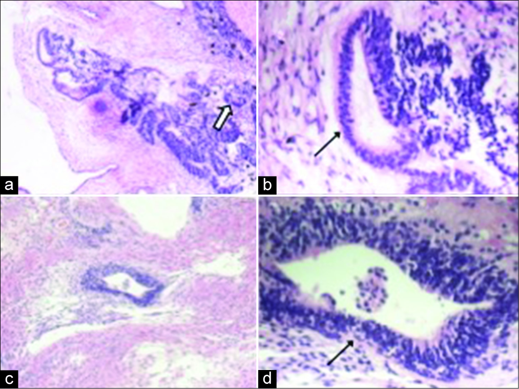 A 32-year-old woman presenting with progressively worsening abdominal pain subsequently diagnosed with bilateral teratomas (immature and mature). Two separate teratomatous areas (a-b and c-d) in the left ovary include neurotubules (black arrow) and neuroepithelial rosettes (white arrow). (Original magnification: (a,c): ×100; (b,d): ×400).