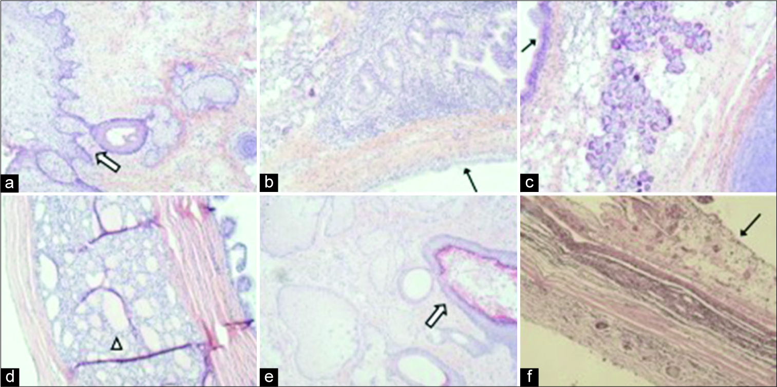 A 32-year-old woman presenting with progressively worsening abdominal pain subsequently diagnosed with bilateral teratomas (immature and mature). Mature teratomatous components in the left ovary (a-c) and right ovary (d-e) include skin appendages (a, white arrow), cartilage (e), thyroid glands (d, arrow head), and respiratory epithelia (b,c,f, black arrow) (Original magnifications: ×100).