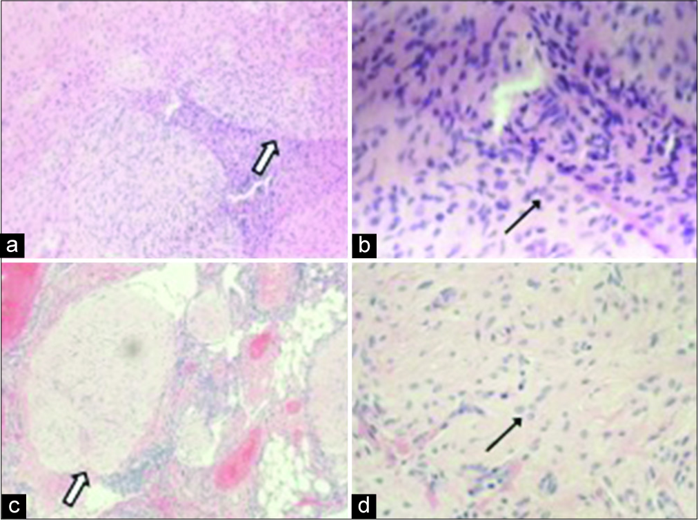 A 32-year-old woman presenting with progressively worsening abdominal pain subsequently diagnosed with bilateral teratomas (immature and mature). Nodules in the rectal peritoneum (a,b) and omentum (c,d) were composed of mature glia tissue with bland looking glial cells (black arrow) forming nodules (white arrow). (Original magnification: a,c: ×100; b,d: ×400)