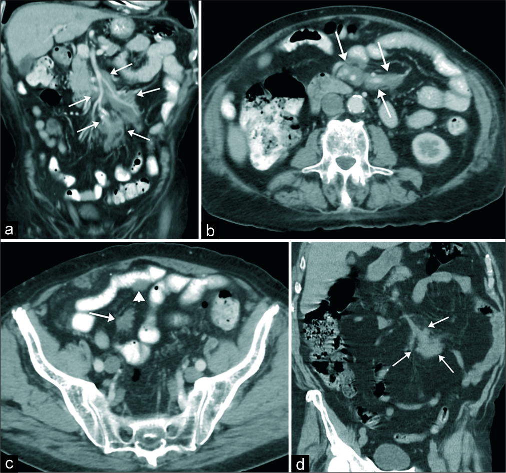 An 80 year-old male with 3 months history of diarrhea and weight loss presented to the emergency department. (a-c) Contrast-enhanced computed tomography (CT) of the abdomen and pelvis obtained in coronal (a) and axial (b and c) planes demonstrates lobulated isoattenuating to the adjacent muscle mass encasing the mesenteric root and extending to the periphery of the vascular bundles (arrows in a and b). There is no evidence of vascular invasion or obstruction. A few smaller soft-tissue deposits were adherent to the serosa of the bowel without bowel obstruction and/or mass effect (arrowhead in c). There was no calcification and no enlarged lymph nodes were appreciated. (d) Contrast-enhanced CT of the abdomen and pelvis obtained 2 years before initial visit demonstrated a focal area of peripheral mesenteric involvement without central mesenteric root deposits (arrows in d).