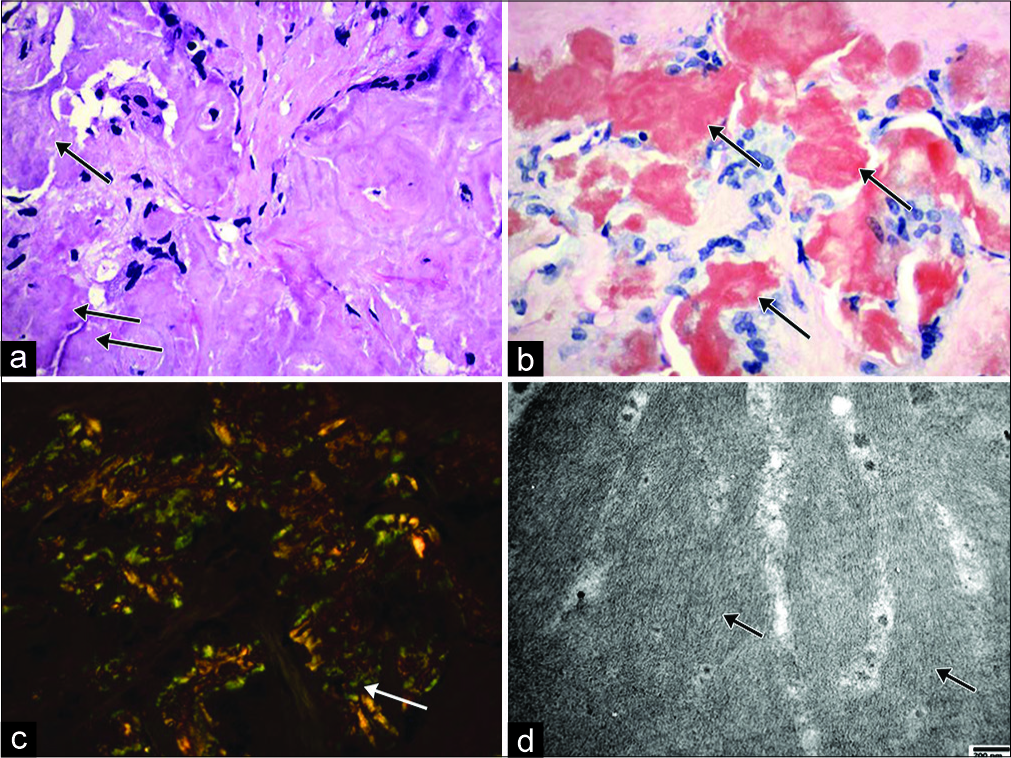 Illustration of mesentery amyloid deposition. (a) Microscopic view showing eosinophilic amorphous amyloid deposition in the mesentery tissue (arrow) (hematoxylin and eosin stain, original magnification ×400); (b) Microscopic view showing Congo red stained amyloid (arrow) (Congo red stain, original magnification ×400). (c) Microscopic view showing apple- green birefringence under polarized light (arrow) (Congo red stain, original magnification ×400); (d) Electron microscopic view showing randomly arranged non-branching fibrils with diameters ranging from 5.62 to 8.19 nm (arrow) (Uranyl acetate and lead citrate stain, original magnification ×40,000).