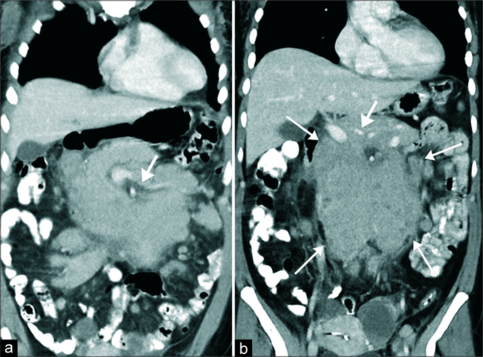 Confluent follicular lymphoma in a 54 year-old women presenting with weight loss. (a and b) Contrast-enhanced computed tomography of the abdomen and pelvis, obtained in coronal (a and b) plane demonstrates lobulated isoattenuating to the adjacent muscle mass encasing the mesenteric root compatible with confluent lymphadenopathy (arrows in a). No vascular compression is noted (thick arrows in a and b). The mass is encasing the central mesenteric root. No adjacent organ invasion is seen.