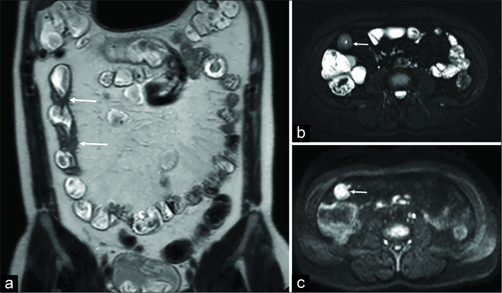 Example of the proposed “fast” protocol in a 40-year- old male patient with confirmed Crohn’s disease. While coronal T2-weighted SSH images (a) yields in recognizing and measuring the bowel wall thickening (arrows), axial SPAIR T2-weighted (b) and DWI (c) sequences are suitable in identifying signs of active inflammation and/or intestinal complications.