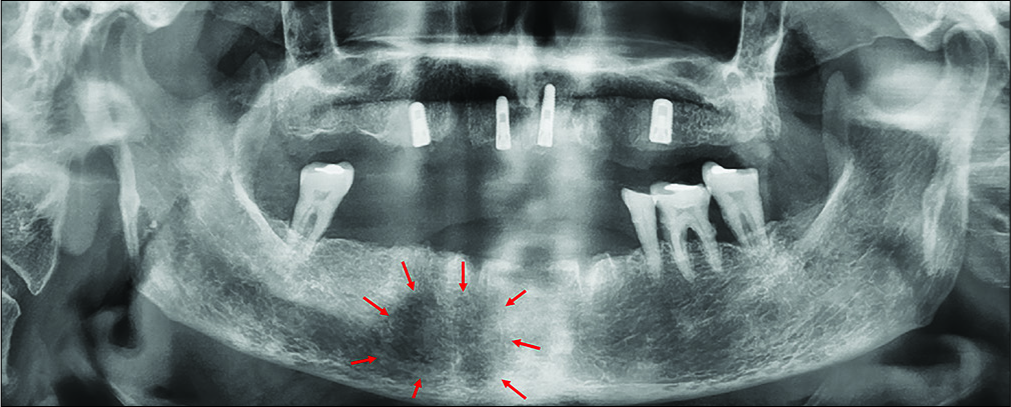 Panoramic radiograph (after extraction) of a 67-year-old woman with subtle vague pain in the right premolar region of the mandible and a paresthesia of the right lower lip and chin showing the ill-defined radiolucent spongeous osteolytic lesion of the right premolar region in the mental foramen area (arrows).