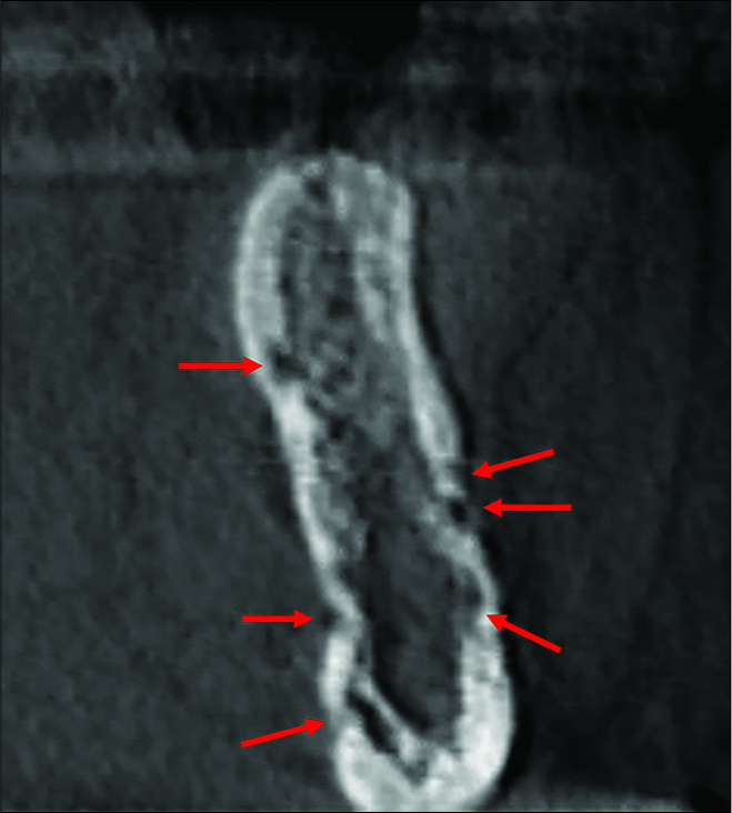 Cone-beam computed tomography cross-sectional 1 mm thick of a 67-year-old woman with subtle vague pain in the right premolar region of the mandible and a paresthesia of the right lower lip and chin showing multiple perforation of the buccal and lingual plate area near the right lower premolar (arrows).
