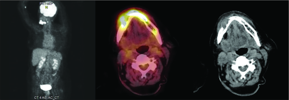 A 67-year-old woman whole body PET scan and high- resolution PET-CT after intravenous injection of 11 mCi of 18F-FDG showing large hyperactive area involving the right mandible.