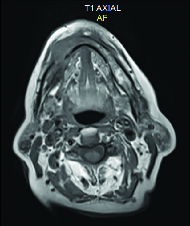 A 67-year-old woman MRI-3T showing lytic lesion of the right anterior mandibular body measuring 3 cm and abnormal signal involving also the left mandibular side, suspicious for tumoral infiltration.