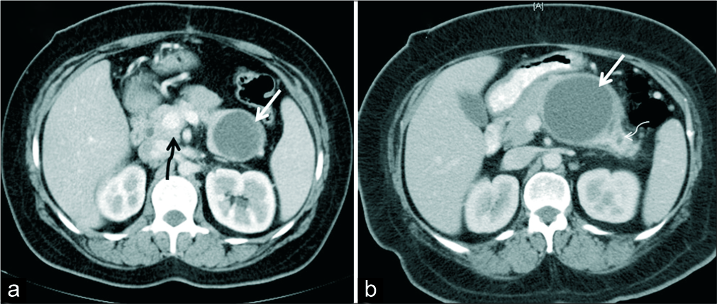 (a) A 38-year-old woman who presented with abdominal pain, axial IV contrast enhanced CT demonstrates a unilocular thin walled cystic lesion in the tail of pancreas (white arrow). Histopathology confirmed diagnosis of pseudocyst. Incidental finding of portal annular pancreas noted (black squiggly arrow). (b) A 50-year-old woman with abdominal pain, axial IV contrast- enhanced CT demonstrates unilocular cystic lesion with no septations or mural nodule (white thick arrow). Histopathology revealed mucinous cystadenoma. Upstream dilatation of MPD is seen in the tail of pancreas (thin white arrow).