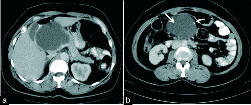 A 33-year-old woman with a palpable abdominal lump. (a) Axial IV contrast-enhanced CT demonstrates a macrocystic lesion in the head of pancreas. (b) CT section at a caudal level shows thin septation (white thick arrow) and a peripheral focus of calcification (white thin arrow) which mimicked a mucinous cystadenoma morphologically. HPE revealed a simple epithelial cyst.