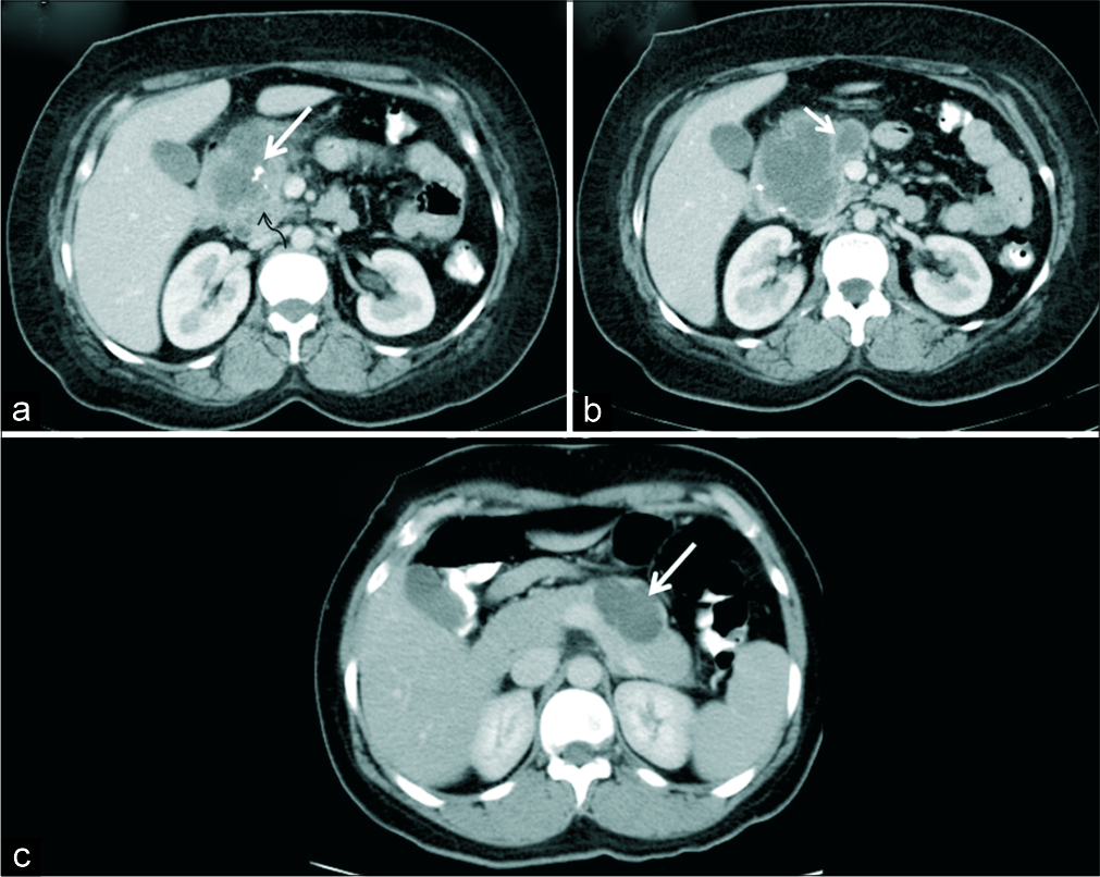 A 39-year-old woman with upper abdominal pain. (a) Axial IV contrast-enhanced CT demonstrates a macrocystic lesion involving the head and uncinate process of pancreas with coarse calcification (white arrow) and solid appearing areas (black arrow). (b) CT sections at a caudal level show thick septations (arrow) mimicking mucinous cystic neoplasm. HPE revealed macrocystic variant of serous cystadenoma. (c) Another 39-year- old woman with incidentally detected pancreatic lesion. (c) Axial IV contrast-enhanced CT demonstrates a macro-oligocystic lesion in the body of pancreas (arrow) which was also a macrocystic variant of serous cystadenoma on HPE.