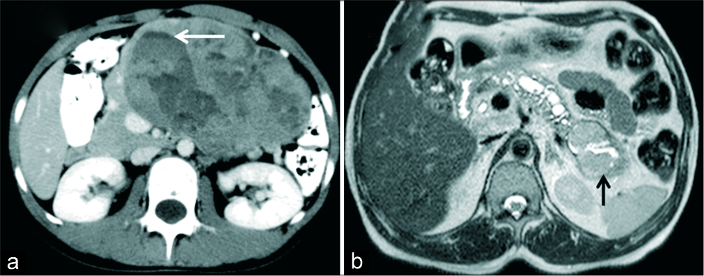 (a) A 18-year-old female with a palpable abdominal mass. (a) Axial IV contrast-enhanced CT demonstrates a large mass involving the body and tail of pancreas with solid cystic morphology. Fluid level is seen within the cystic component (arrow). Imaging features consistent with solid pseudopapillary neoplasm (SPN) was also confirmed on HPE. (b) A 48-year-old man with suspected pancreatic mass. MRI T2 axial images show dilated MPD and lobulated cystic lesion with T2 intermediate signal intensity solid component (black arrow) in the tail communicating with MPD in keeping with the diagnosis of IPMN. HPE showed high grade IPMN, pancreaticoduodenal type with foci of invasive carcinoma.