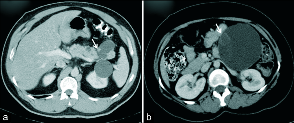 (a) A 51-year-old man with history of pancreatitis in the past. (a) Axial IV contrast-enhanced CT demonstrates cystic lesion in the tail of pancreas with suspected communication with MPD and an eccentric mural nodule (arrow). Diagnosis of intraductal papillary mucinous neoplasm was made. HPE showed IPMN with low grade dysplasia. (b) A 35-year-old woman with abdominal pain. (b) Axial IV contrast-enhanced CT demonstrates a macrocystic lesion suggestive of mucinous cystic neoplasm with a probable mural nodule (arrow) which was concerning for malignancy, HPE revealed mucinous cystadenoma with no evidence of malignancy.