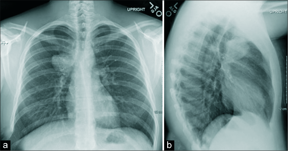 Chest radiograph frontal (a) and lateral (b) views of a 23-year-old male demonstrate rounded mass-like opacity (arrows) along the superior right paramediastinal border in the right upper lobe.