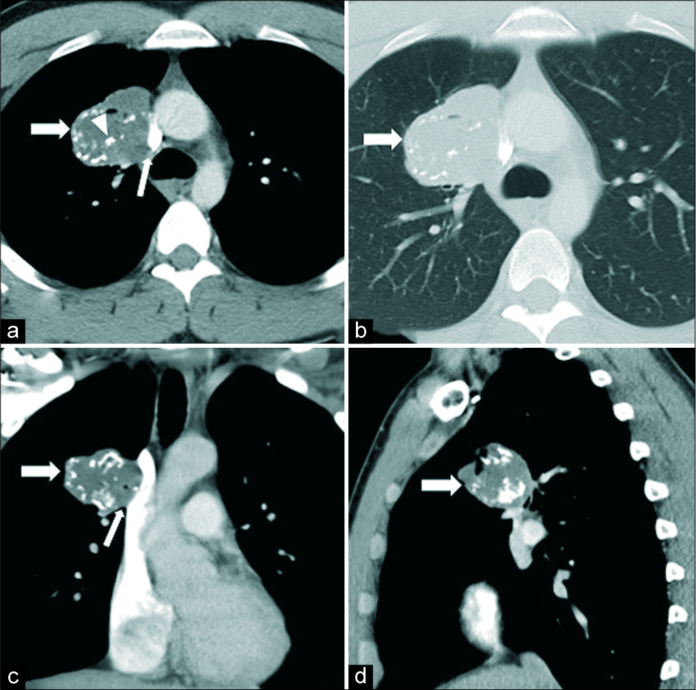 Contrast-enhanced computed tomography chest in axial (a and b), coronal (c), and sagittal (d) views of a 23-year-old male revealed a large soft tissue mass in the right upper lobe (thick arrows) along the right paramediastinal border abutting the adjacent mediastinal vascular structures (thin arrows), with multiple intrinsic calcifications (arrowhead). Surgery resection of the mass was performed and the lesion proved to be a low-grade primary lung chondrosarcoma.