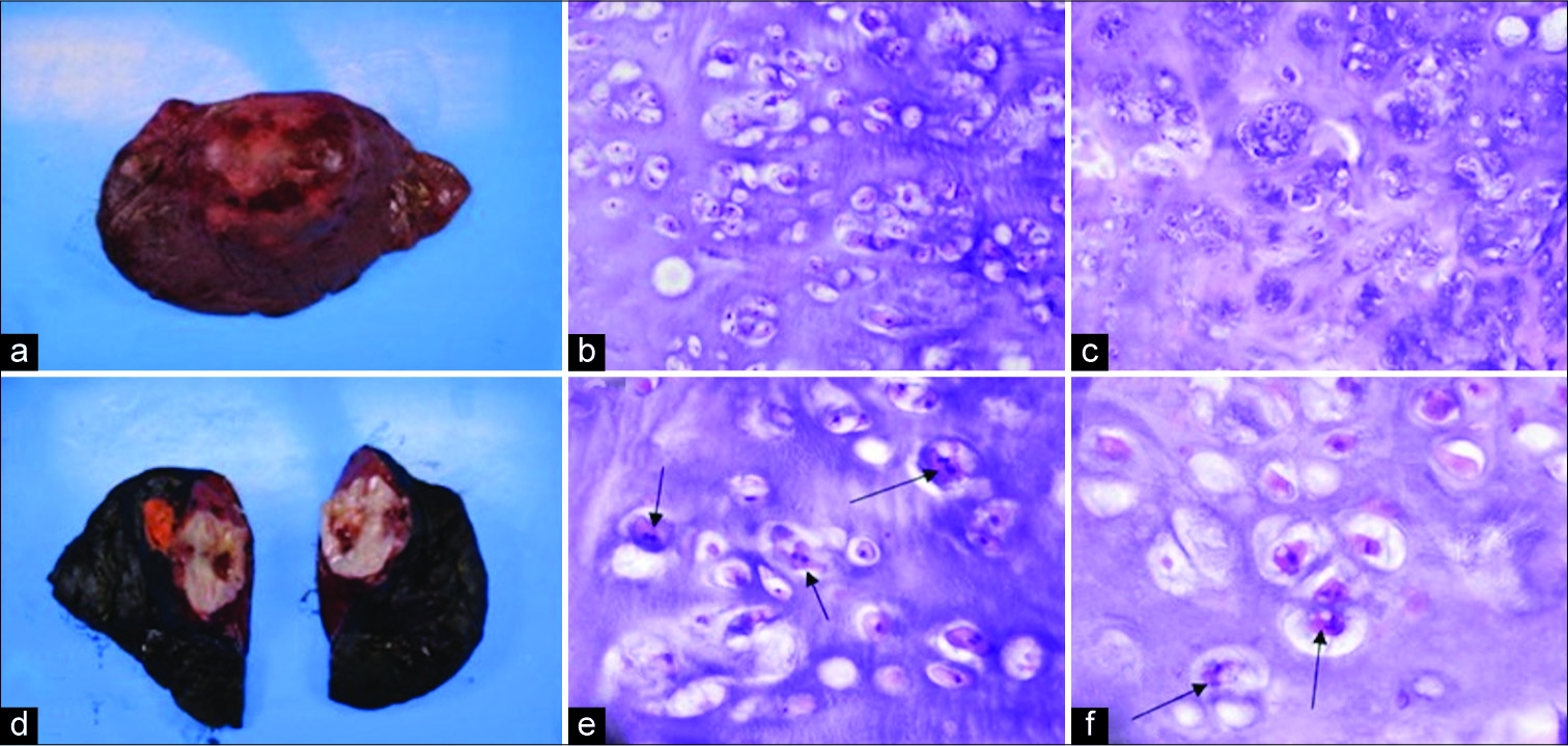 Resected 5 cm primary chondrosarcoma from a 23-year-old male from the upper lobe of right lung through exploratory video-assisted thoracoscopic surgery, (a and b) gross appearance of resected mass, (c-f) histopathological findings of primary pulmonary chondrosarcoma with H and E stain, arrows point toward binuclear chondrocytes with nuclear crowding, which suggest the presence of a low-grade chondrosarcoma.