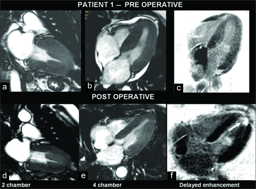 A 55-year-old man with hypertrophic cardiomyopathy presented with exertional dyspnea. Pre- and post-operative magnetic resonance imaging images show hypertrophied myocardium in the left ventricle (LV) views (a-e). Septal hypertrophy is evident. Gadolinium-enhanced image shows enhancing myocardial scar which is noted at the LV apex (f) (open arrow).