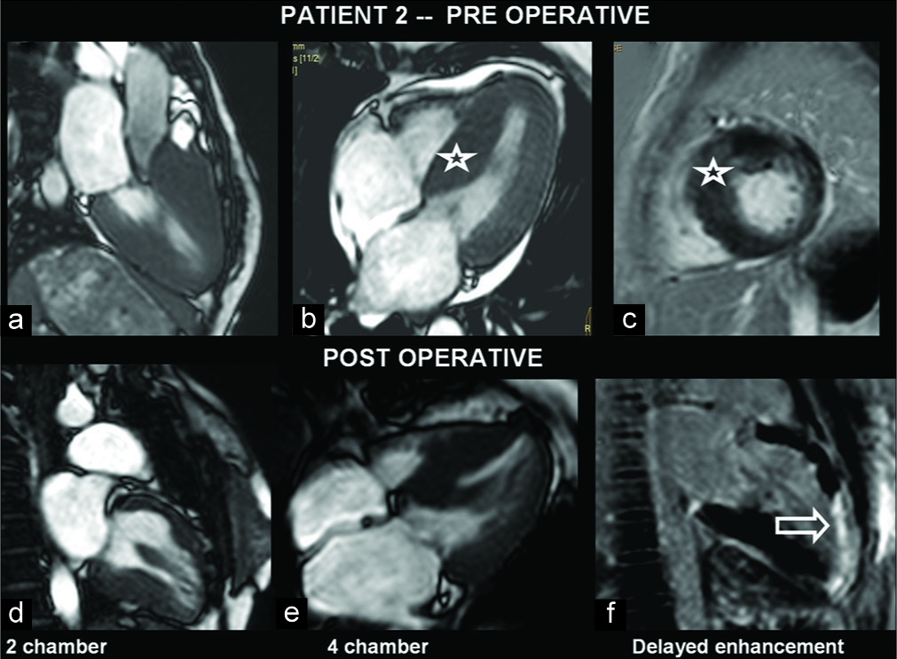 A 27-year-old female with hypertrophic cardiomyopathy presented with dyspnea. Pre- and post-operative images show hypertrophied myocardium, especially in the septum in the left ventricle (LV) views (a-e). Gadolinium-enhanced image shows enhancing myocardial scar which is noted at the LV anterior wall and apex (f) (open arrow).