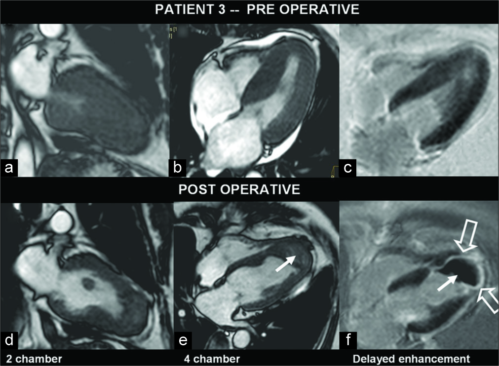 A 57-year-old man with hypertrophic cardiomyopathy, known to have a triple-vessel disease, presented with increasing angina. Pre- and post-operative images of myocardium in various left ventricle (LV) views (a-e) show predominant septal hypertrophy. In the post-operative gadolinium-enhanced image, there is enhancing myocardial scar (open arrows) and clot at LV apex (f) (arrows).