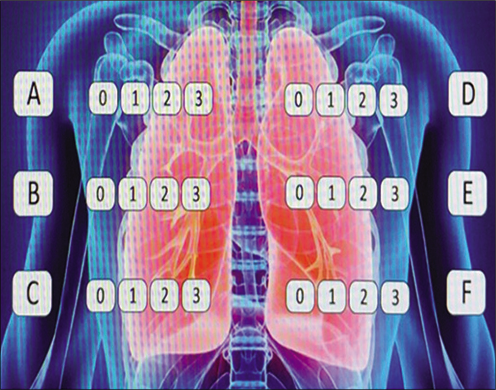 The software banner depicting a lung image to obtain the CXR “COVID-19 score.” This picture shows the three different areas of each lung (a-c-b for the left and d-e-f for the right), the upper area (from the apices to the profile of the aortic arch – Line A), the intermediate area (from the Line A to the lower edge of the inferior pulmonary – Line B), and the lower (from the Line B to the diaphragm).