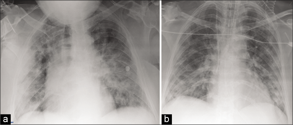 (a) 69-year-old man with pneumonia disease who presented with fever, cough, and dyspnea. Portable CXR image shows lungs with bilateral pulmonary involvement with widespread interstitial disease and areas of consolidation in different zones of each lung with CXR “COVID-19 score” value of 18; (b) 64-year- old man with respiratory distress (intubated and subjected to mechanical ventilation). Portable CXR image shows lungs with multiple small areas of lung consolidation affecting the whole lung parenchyma bilaterally with CXR “COVID-19 score” value of 18.