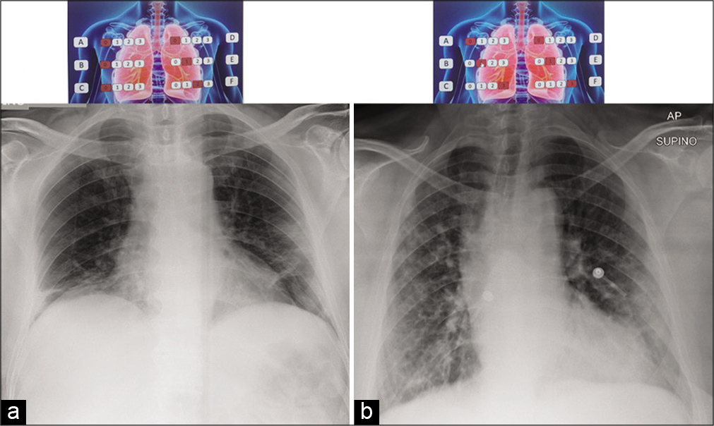 65-year-old man arrived in the emergency room with sudden high fever (39.8°C) and intense cough. (a) The first portable CXR examination shows lungs with minimal disventilative bibasal areas associated with reticular and hazy medium and the lower left lobe opacities (with interstitial changes predominance) with CXR “COVID-19 score” value of 3. (b) After a week, the second portable CXR exam shows lungs with progressive worsening with bilateral medium and lower lobe consolidations (with alveolar consolidation predominance) with CXR “COVID-19 score” value of 8.