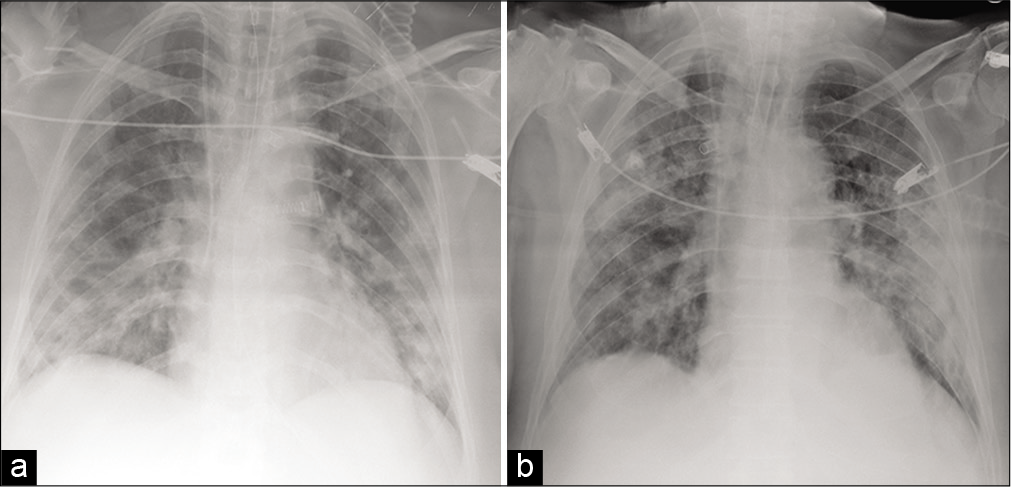 (a) 67-year-old man with respiratory distress (intubated and subjected to mechanical ventilation). Portable CXR image shows lungs with multiple small areas of lung consolidation (with alveolar consolidation predominance) in the whole lung parenchyma bilaterally with CXR “COVID-19 score” value of 16. (b) 3-years-old man with respiratory distress (intubated and subjected to mechanical ventilation). Portable CXR image shows lungs with reticular and hazy medium and lower bilateral lobe opacities (with interstitial changes predominance) with CXR “COVID-19 score” value of 12.